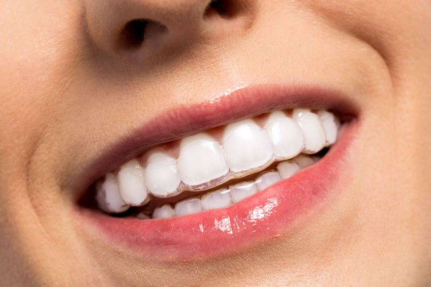 Invisalign® Invisalign® close up of a woman smiling with Invisalign® on.